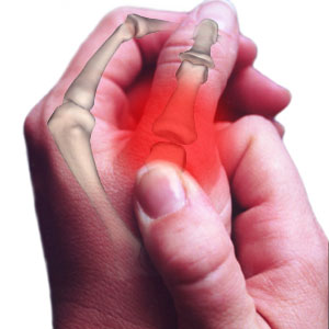 Osteoarthritis - Pain In a Hand