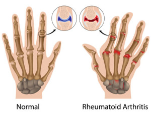 rheumatoid-arthritis-300×228 Rheumatoid Arthritis Comparison Image